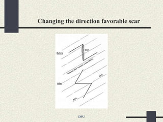 Changing the direction favorable scar




              DPU
 