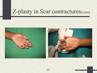 Z-plasty in Scar contractures(cont)




               DPU
 