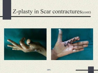 Z-plasty in Scar contractures(cont)




               DPU
 