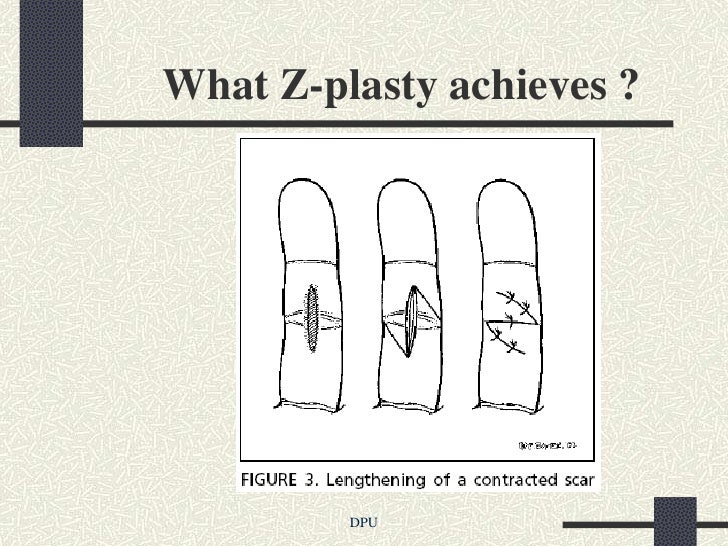 Z plasty