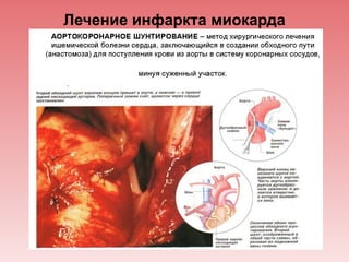 Лечение инфаркта миокарда
 