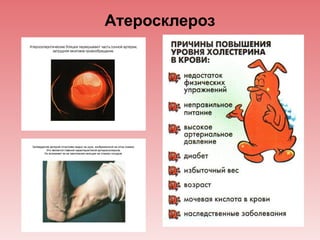 Атеросклероз
 