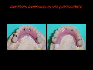 PRÓTESIS PROVISORIAS SIN CANTILLEVER
 