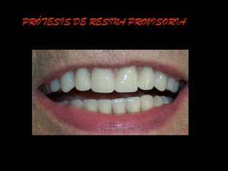 PRÓTESIS DE RESINA PROVISORIA
 