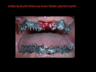 FERULIZAR CON DURALAY PARA TENER AJUSTE PASIVO
 