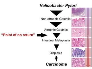Diagnosis and Treatment of Helicobacter Pylori Infection | PDF
