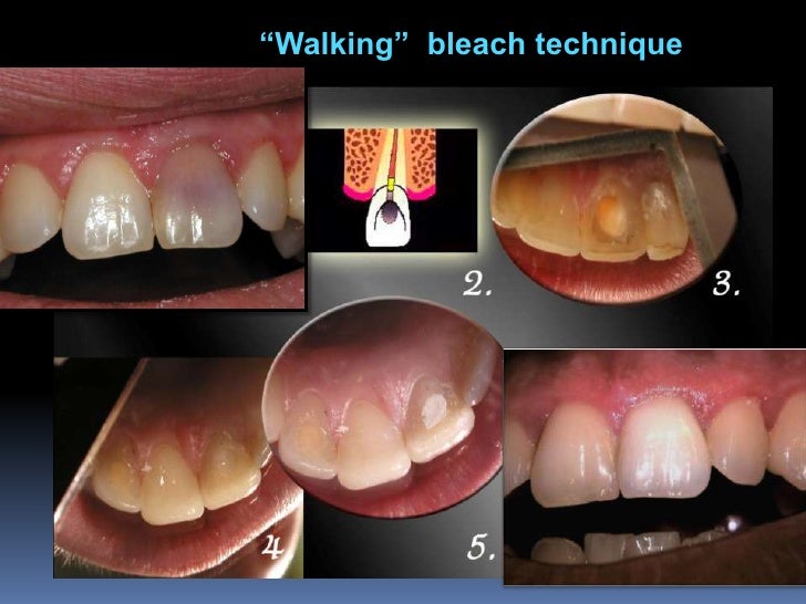 bleaching teeth zoom bleaching light