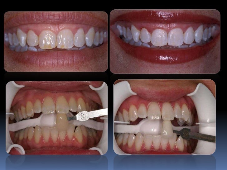 Bleaching Teeth