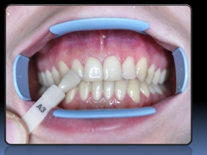 Bleaching Teeth
