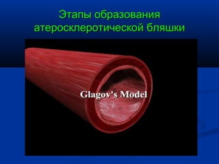 Этапы образования
атеросклеротической бляшки
 