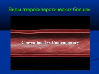Виды атеросклеротических бляшек
 