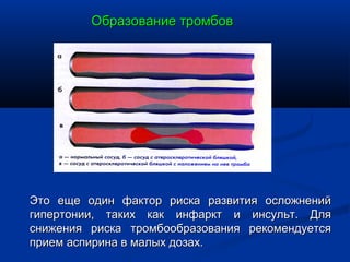 Образование тромбов




Это еще один фактор риска развития осложнений
гипертонии, таких как инфаркт и инсульт. Для
снижения риска тромбообразования рекомендуется
прием аспирина в малых дозах.
 