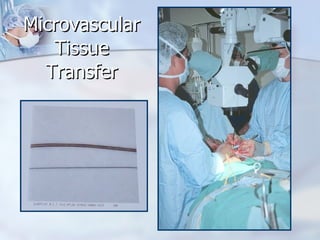 Microvascular Tissue Transfer 