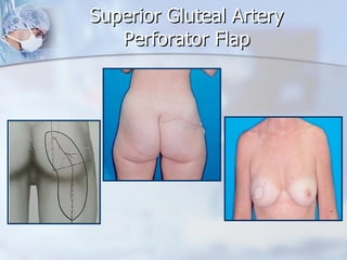 Superior Gluteal Artery Perforator Flap 