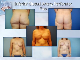 Inferior Gluteal Artery Perforator Flap 