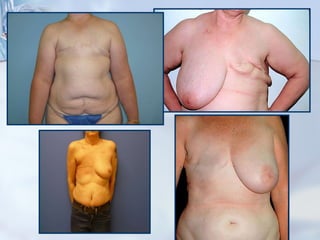 Mastectomy Defect 