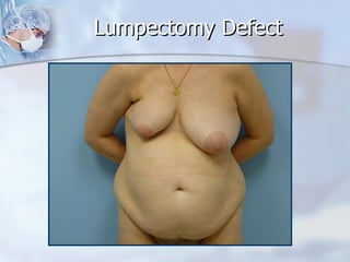Lumpectomy Defect 