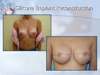 Silicone Implant Reconstruction 