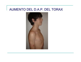 AUMENTO DEL D.A.P. DEL TORAX
 