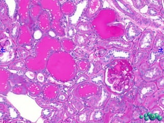 Pathological Evaluation of Kidney
• Glomerulopathy: Changes in the renal glomeruli consisted of one or more of the following:
increased cellularity in the mesangium; increased in mesangial connective tissue; thickening of
Bowman’s capsule; hypertrophy of capsular epithelium; dilation of the capsular space. Individual
glomeruli appeared moderately enlarged. The lesions were highly variable within individual
glomeruli and between glomeruli within a kidney. The changes were most usually segmental,
although a rare glomeruli was fibrotic (condensed). Expanded mesangial material stained
positively with the PAS stain and to a lesser extent with the Trichrome stain.
• Tubular dilation/degeneration: This change was mainly in the cortex and consisted of irregularly
dilated, empty tubules, that sometimes were lined by cuboidal epithelium that stained basophilic
compared to the expected normal eosinophilic tubular epithelium. In some individual tubules the
epithelium were flattened. These dilated/degenerate tubules were randomly scattered throughout
the cortex, and sometimes were associated with protein casts and/or non-suppurative inflammation
(see below). Focal mild increases in fibrous connective tissue within the interstitial space was
present, frequently in association with the interstitial inflammatory response, but not restrictively so.
• Protein casts: Individual tubules contained acellular, uniformly staining eosinophilic material
consistent with protein. These protein casts were present in the cortex and in the medulla, as well
as at the cortico-medullary junction in various sections. Often, several such dilated tubules
containing protein casts were clustered together, usually in the cortex.
• Inflammation: The inflammatory process consisted of focal collections of lymphocytes and
macrophages, which were seen in the cortical interstitial space, adjacent to individual glomeruli
and individual blood vessels, and in association with the renal pelvic epithelium.
12
 