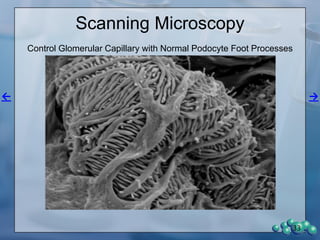 Glomerular Proteomics
• Nondiabetic, prediabetic and diabetic
glomeruli were collected and analyzed for
protein expression.
• Data were analyzed using volcano plotting
to show the differences in expression of
proteins in the three groups.
• The different groups were compared in the
next three slides (33-35).
• Slide 36 demonstrates down-regulation of
glyoxalase 1 with diabetes.
33
 