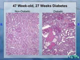 Summary-The effect of Lisinopril on nephropathy in the
ZDSD rat
• ZDSD weight decreased in both untreated and
treated diabetic groups with greater decreases in the
treated group.
• Blood levels of glucose, creatinine and BUN
increased with Lisinopril treatment.
• Urinary albumin decreased significantly (~87%) in the
Lisinopril treated group while it increased significantly
(~400%) in the untreated diabetic ZDSD rats.
• Irrespective of the time the ZDSD rats had diabetes
and their initial level of urinary albumin, the age
subgroups of animals had 82-91% decreases in the
amount of urinary albumin excreted after 4 weeks of
Lisinopril treatment.
43
 