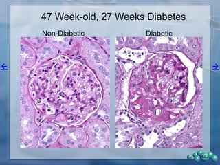 Summary: Diabetic Nephropathy (DN) in the ZDSD Rat.
The following are supported by data in this slide set!
• Diabetic nephropathy (DN) develops with spontaneous
or synchronized diabetes.
• Increased urinary albumin and other urinary biomarkers
increase with duration of diabetes.
• Increased BUN and blood creatinine levels.
• LM and EM morphological changes consistent with DN.
• Glomerular BM thickening and podocyte effacement.
• Changes in glomerular protein expression similar to
human DN.
• Urinary albumin secretion significantly improved with
ACE inhibitor (Lisinopril) treatment, similar to human DN.
• ACE-I treatment effective at all stages of DN examined.
44
 