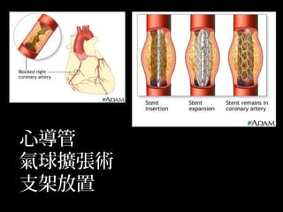 心導管
氣球擴張術
支架放置
 