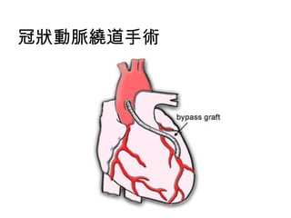 冠狀動脈繞道手術
 