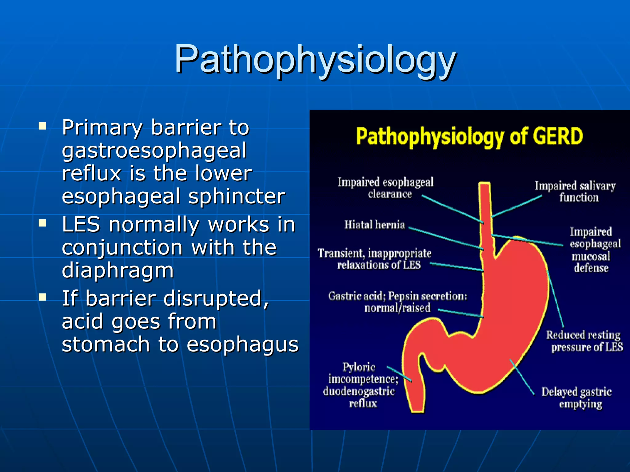 Pathophysiology Primary barrier to gastroesophageal reflux is the lower esophageal sphincter LES normally works in conjunction with the diaphragm If barrier disrupted, acid goes from stomach to esophagus 