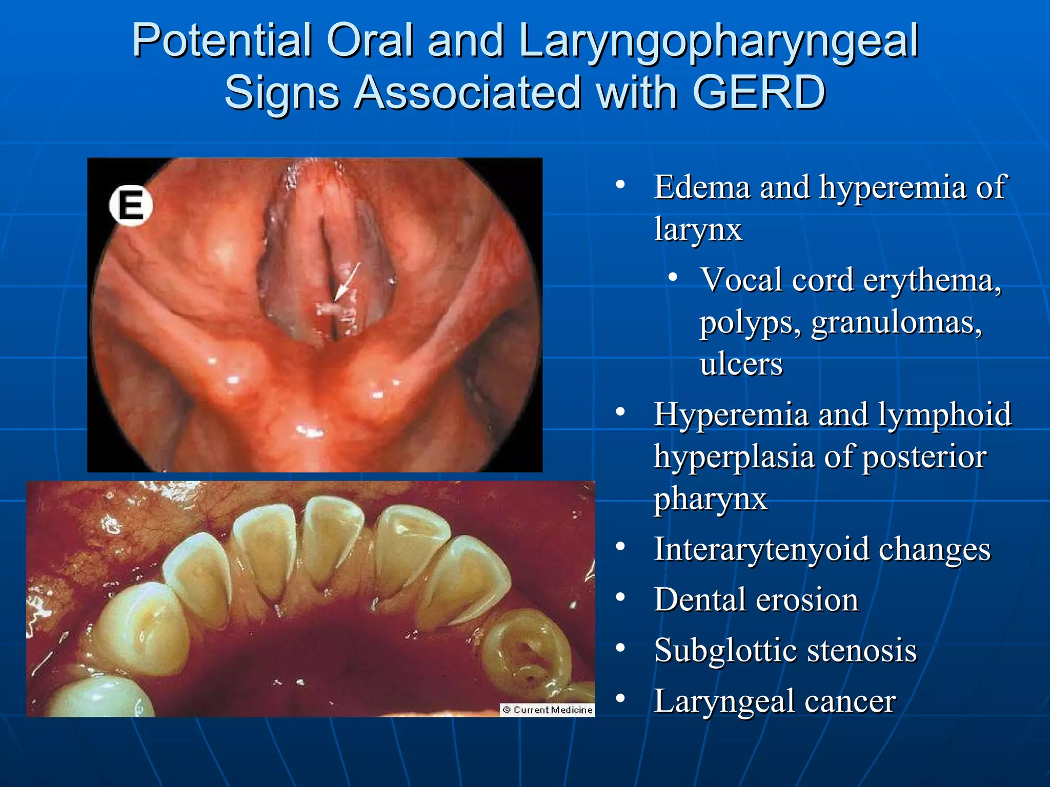 Potential Oral and Laryngopharyngeal Signs Associated with GERD Edema and hyperemia of larynx Vocal cord erythema, polyps, granulomas, ulcers Hyperemia and lymphoid hyperplasia of posterior pharynx  Interarytenyoid changes Dental erosion Subglottic stenosis Laryngeal cancer 