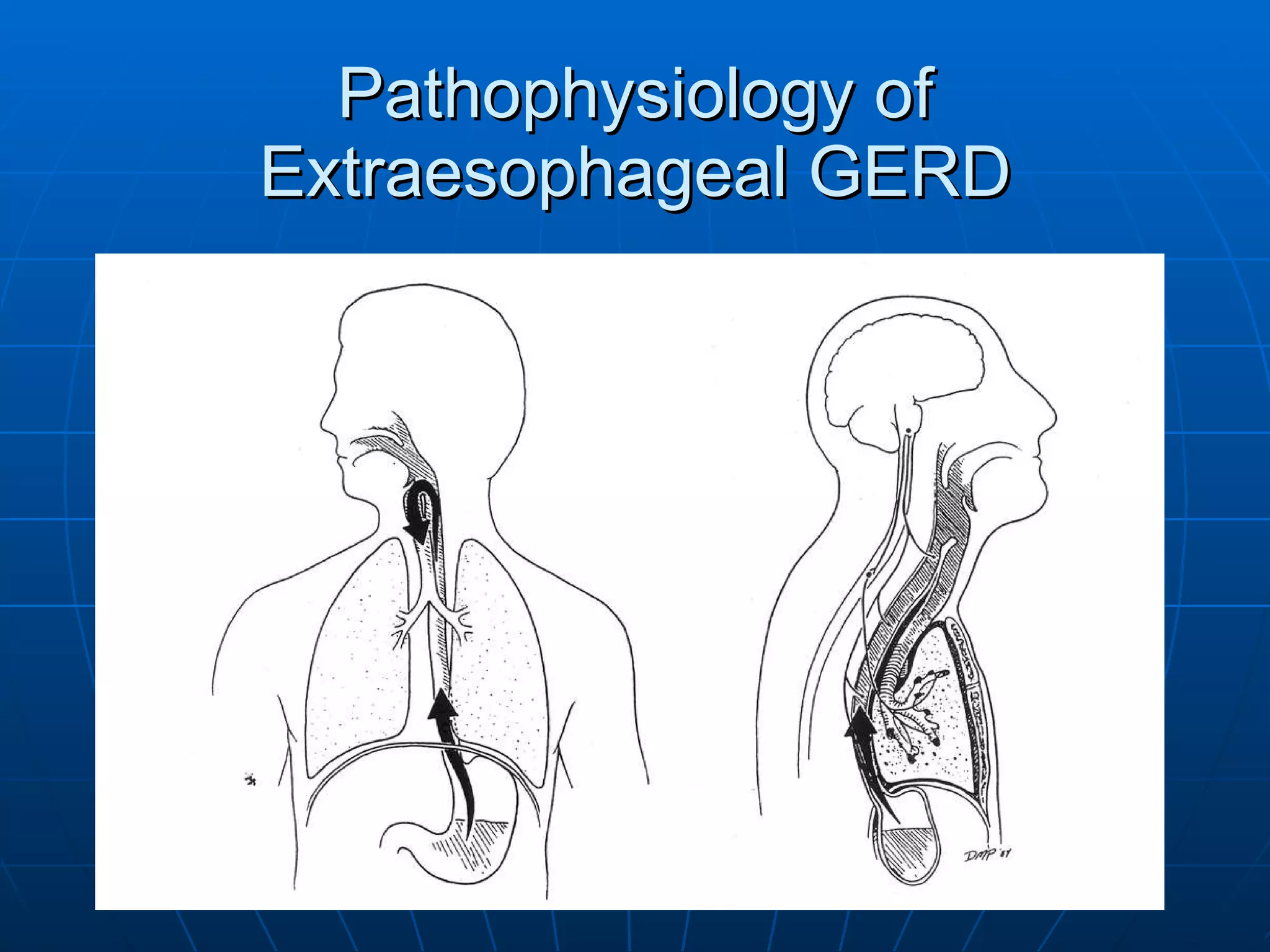 Pathophysiology of Extraesophageal GERD 
