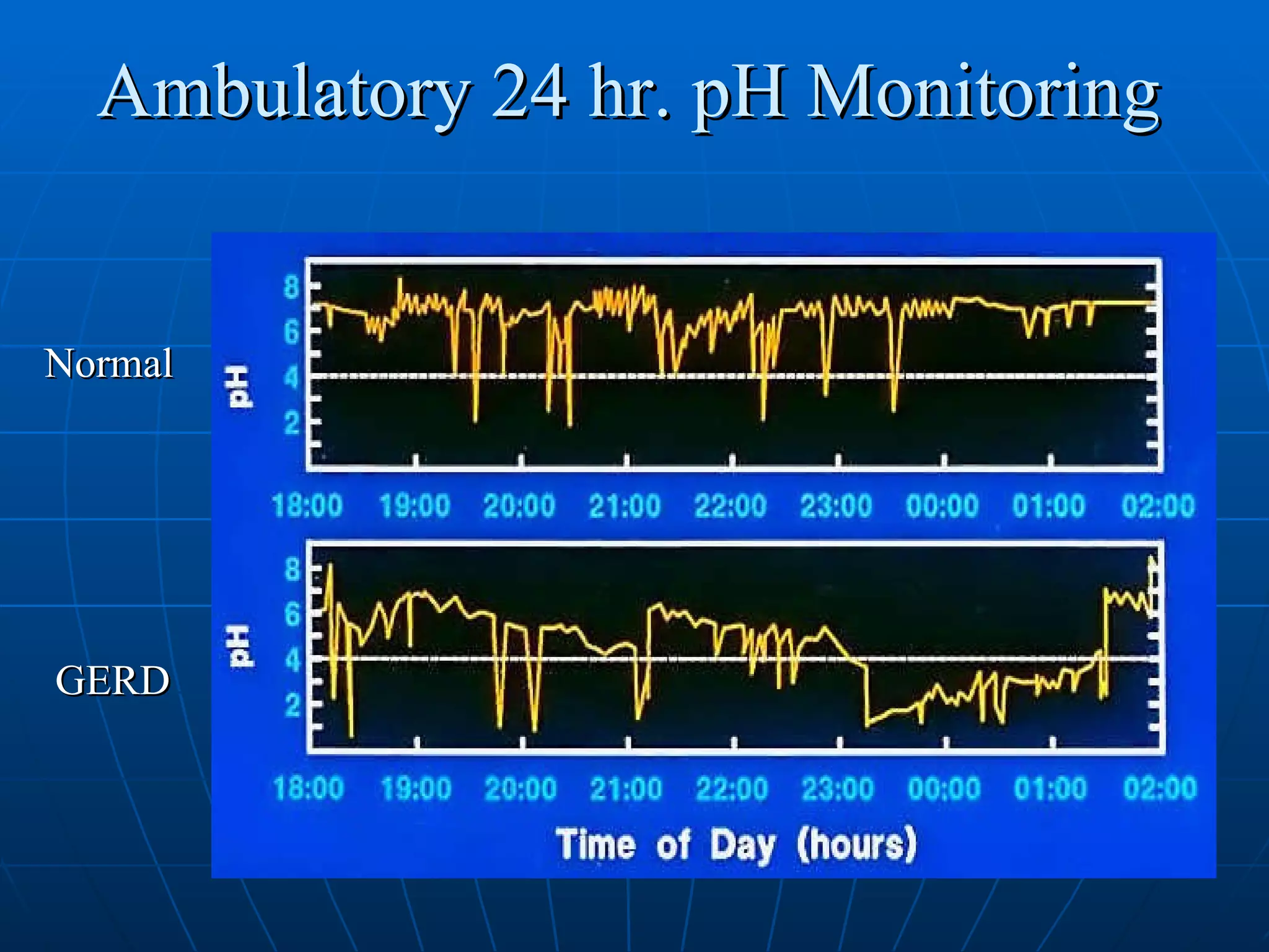 Ambulatory 24 hr. pH Monitoring Normal GERD 