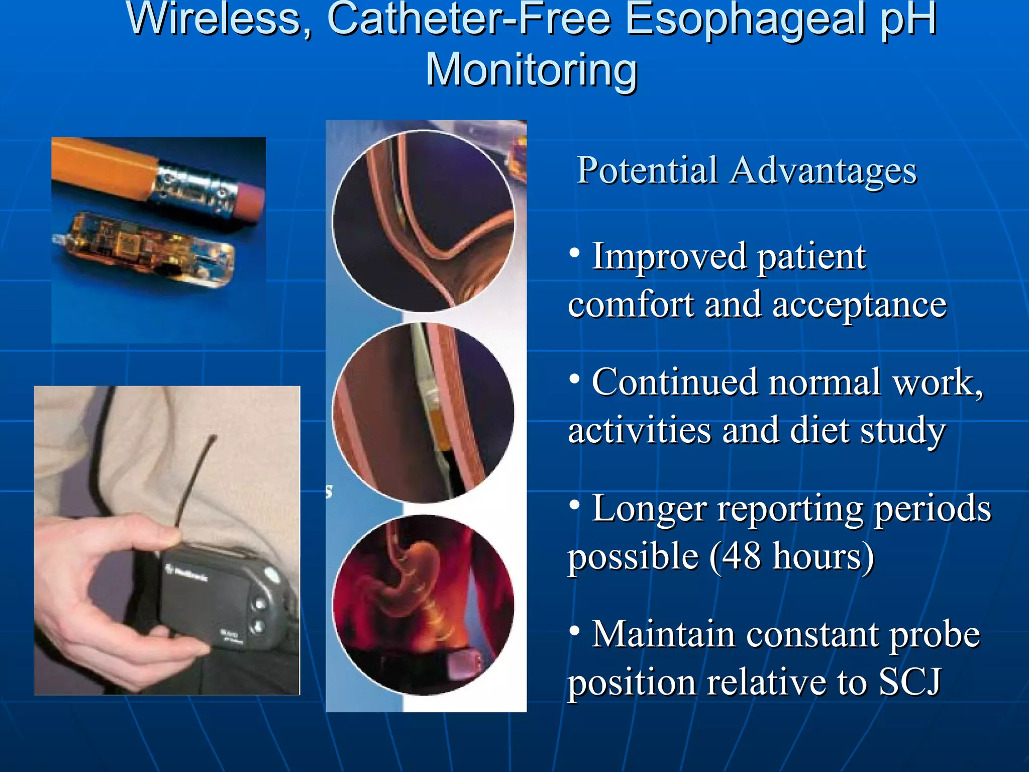 Wireless, Catheter-Free Esophageal pH Monitoring Improved patient comfort and acceptance Continued normal work, activities and diet study Longer reporting periods possible (48 hours) Maintain constant probe position relative to SCJ Potential Advantages 