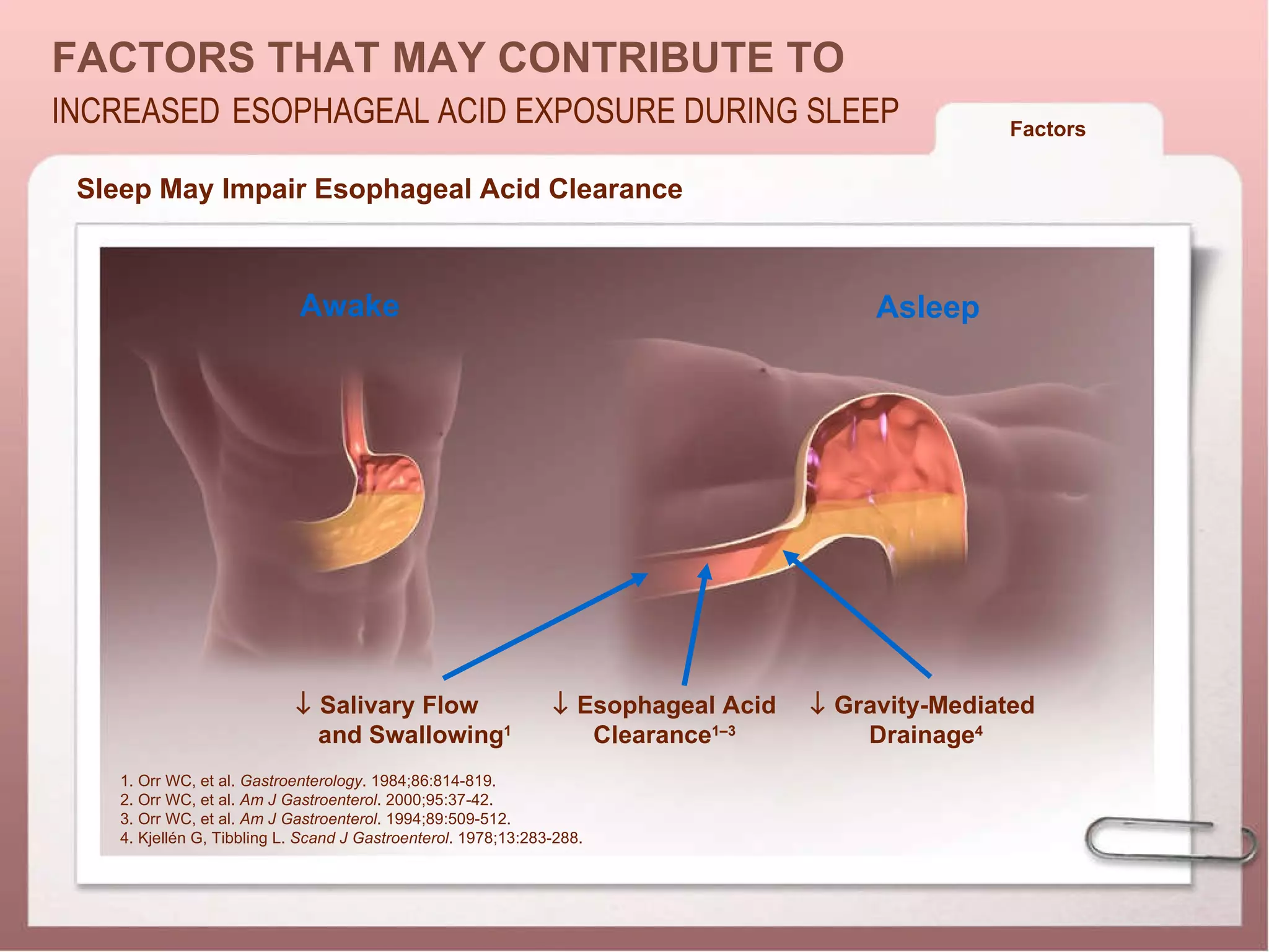 1. Orr WC, et al.  Gastroenterology . 1984;86:814-819. 2. Orr WC, et al.  Am J Gastroenterol . 2000;95:37-42. 3. Orr WC, et al.  Am J Gastroenterol . 1994;89:509-512. 4. Kjellén G, Tibbling L.  Scand J Gastroenterol . 1978;13:283-288.  Sleep May Impair Esophageal Acid Clearance    Gravity-Mediated Drainage 4    Esophageal Acid Clearance 1–3    Salivary Flow  and Swallowing 1 Asleep Awake Factors      FACTORS THAT MAY CONTRIBUTE TO INCREASED   ESOPHAGEAL ACID EXPOSURE DURING SLEEP 