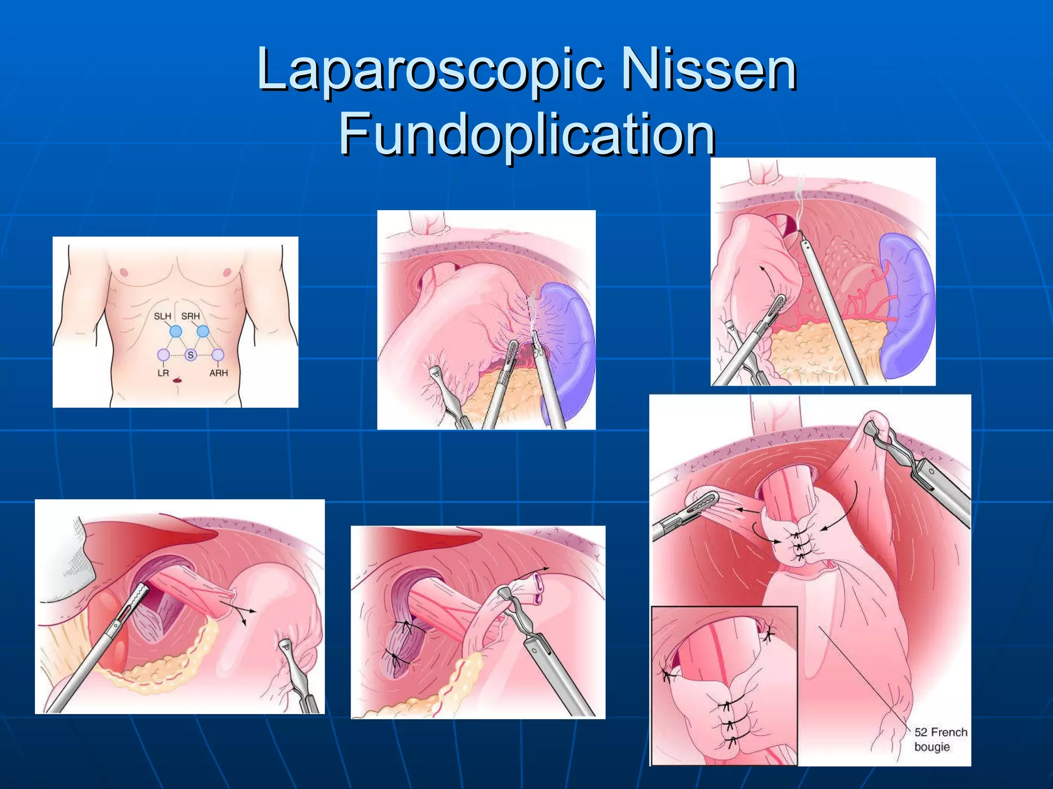 Laparoscopic Nissen Fundoplication 