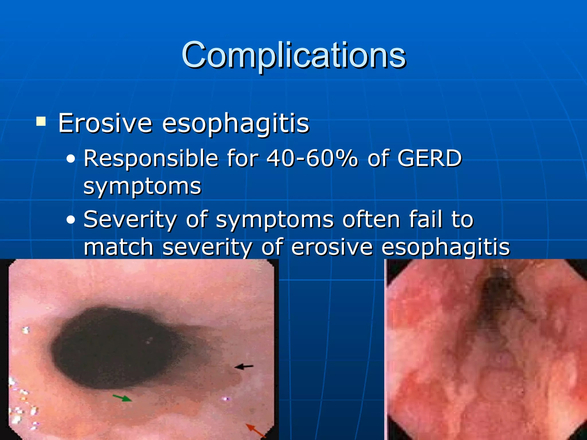 Complications Erosive esophagitis Responsible for 40-60% of GERD symptoms Severity of symptoms often fail to match severity of erosive esophagitis 