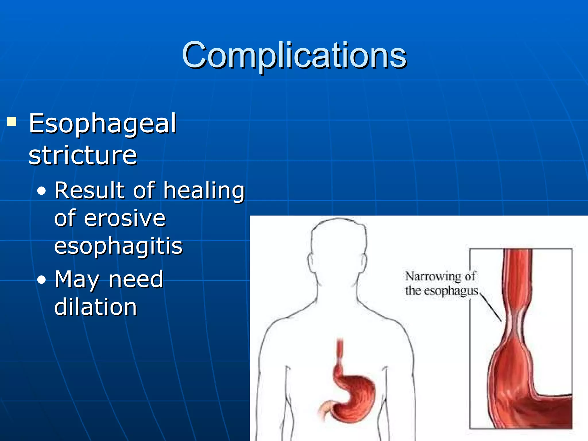 Complications Esophageal stricture Result of healing of erosive esophagitis May need dilation 