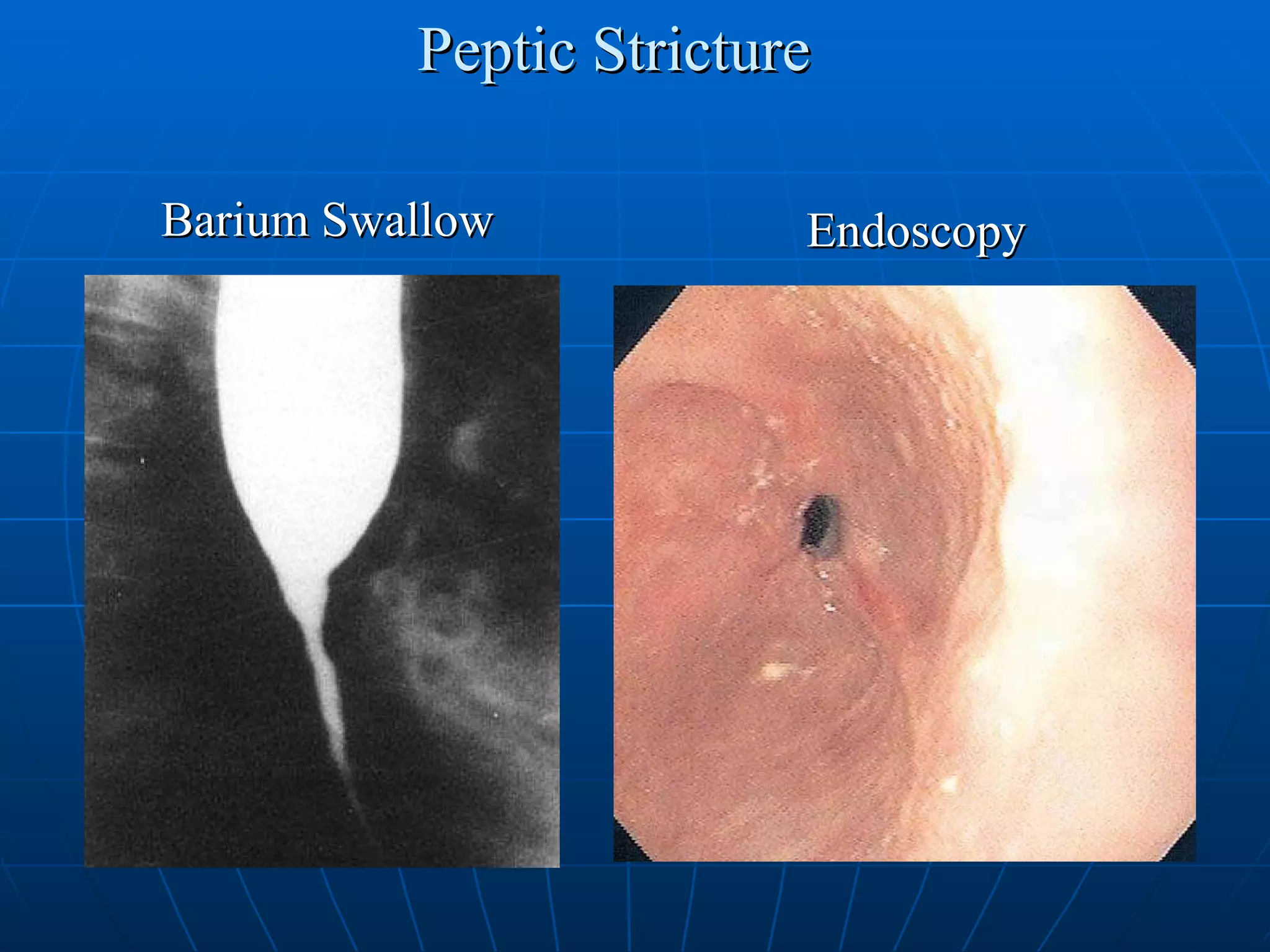 Peptic Stricture Barium Swallow Endoscopy 