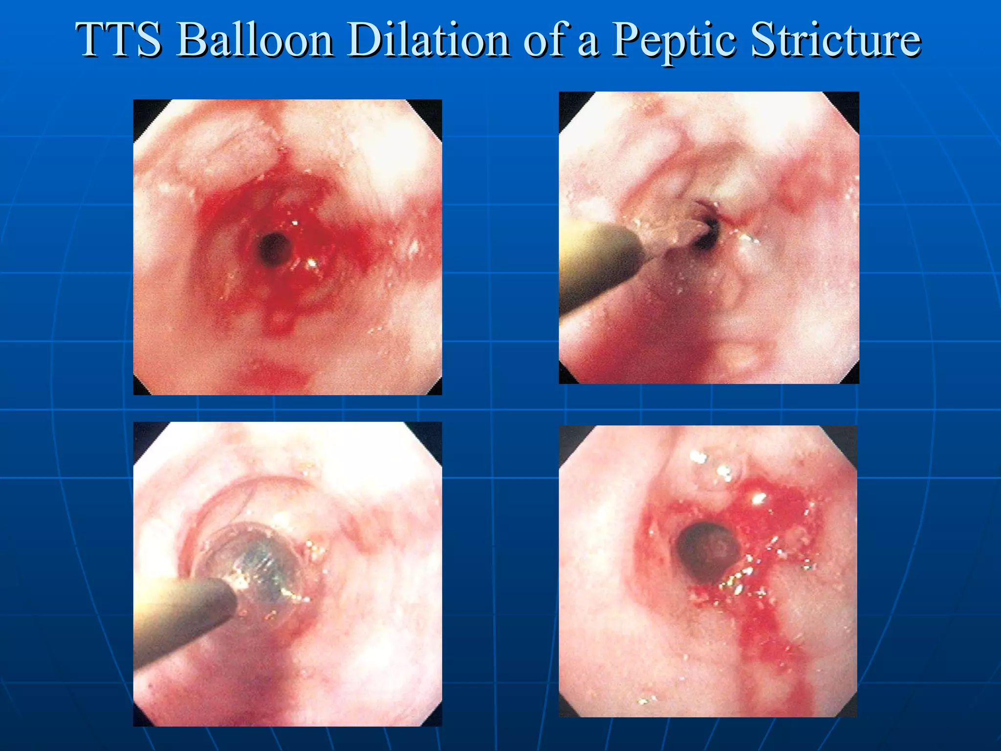 TTS Balloon Dilation of a Peptic Stricture 