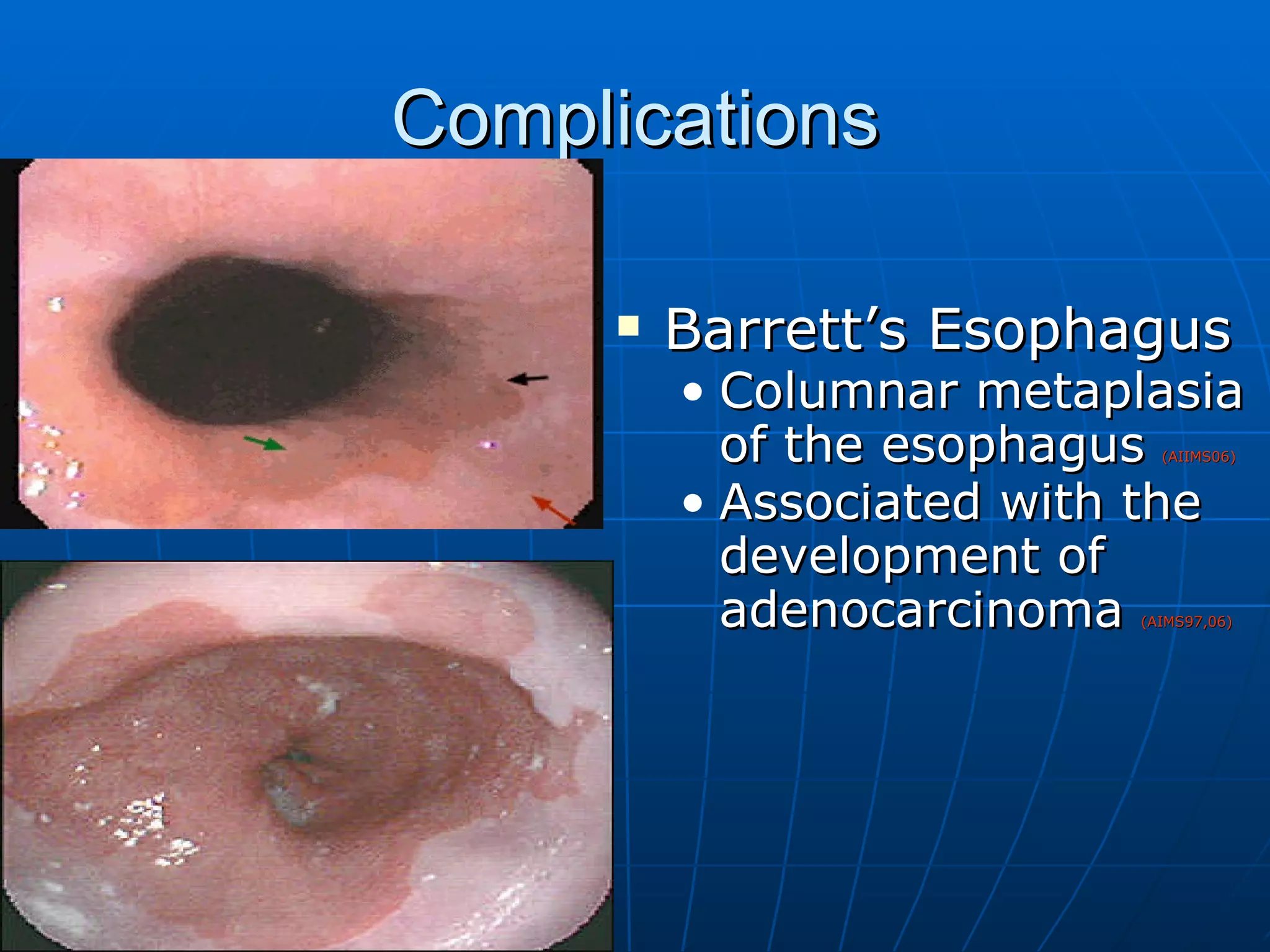 Complications Barrett’s Esophagus Columnar metaplasia of the esophagus  (AIIMS06) Associated with the development of adenocarcinoma  (AIMS97,06) 