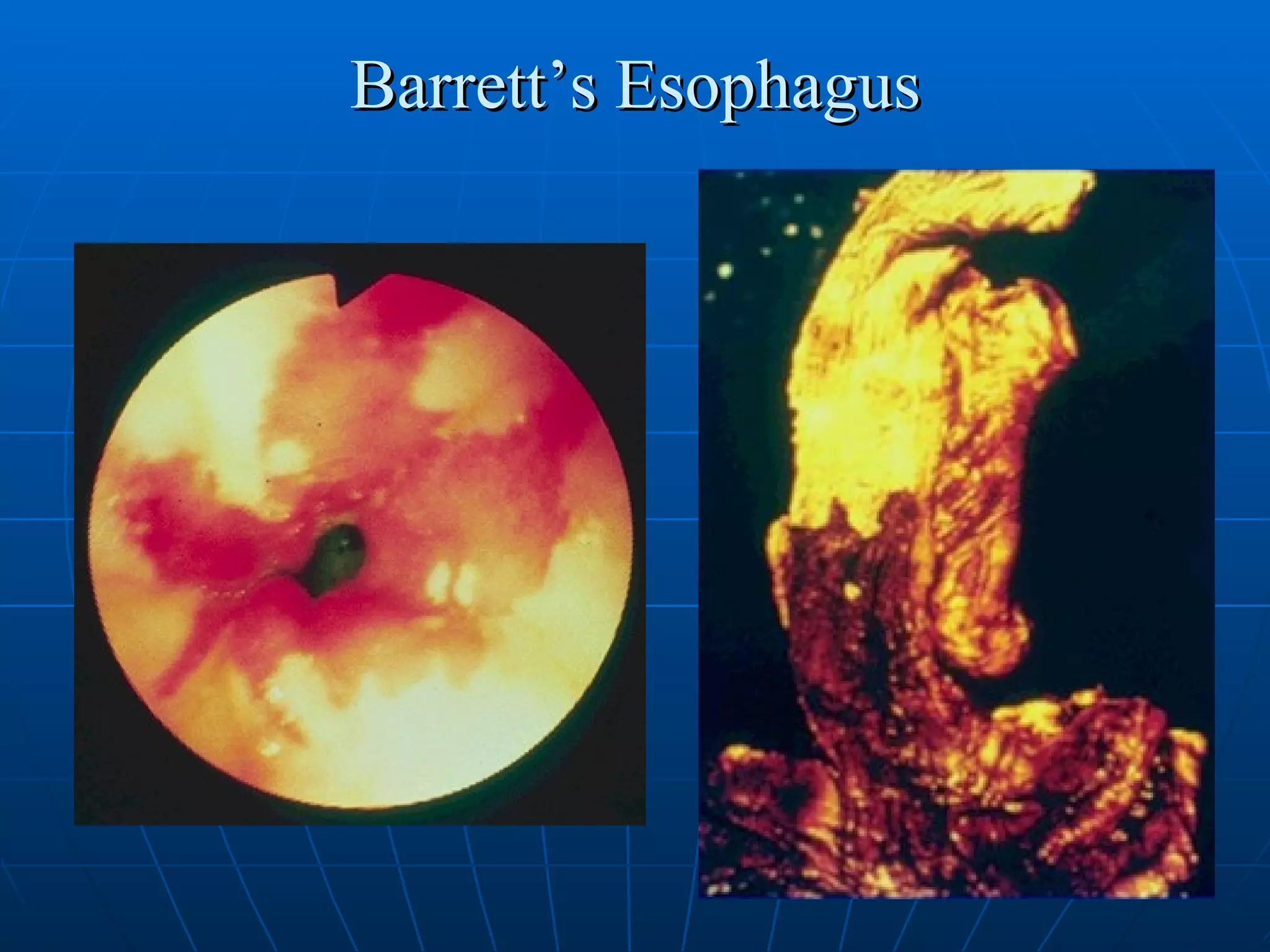 Barrett’s Esophagus 