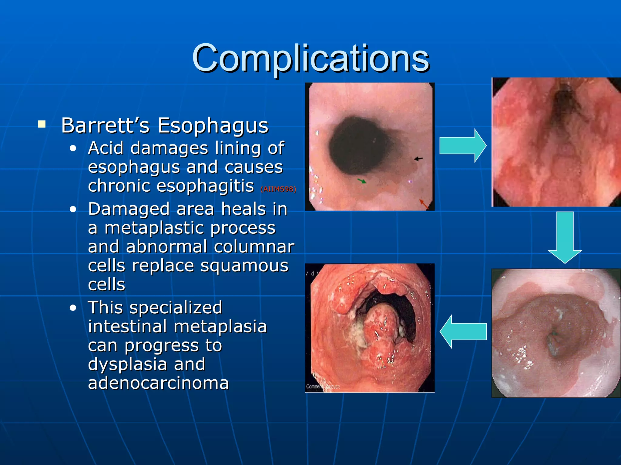 Complications Barrett’s Esophagus Acid damages lining of esophagus and causes chronic esophagitis  (AIIMS98) Damaged area heals in a metaplastic process and abnormal columnar cells replace squamous cells This specialized intestinal metaplasia can progress to dysplasia and adenocarcinoma 