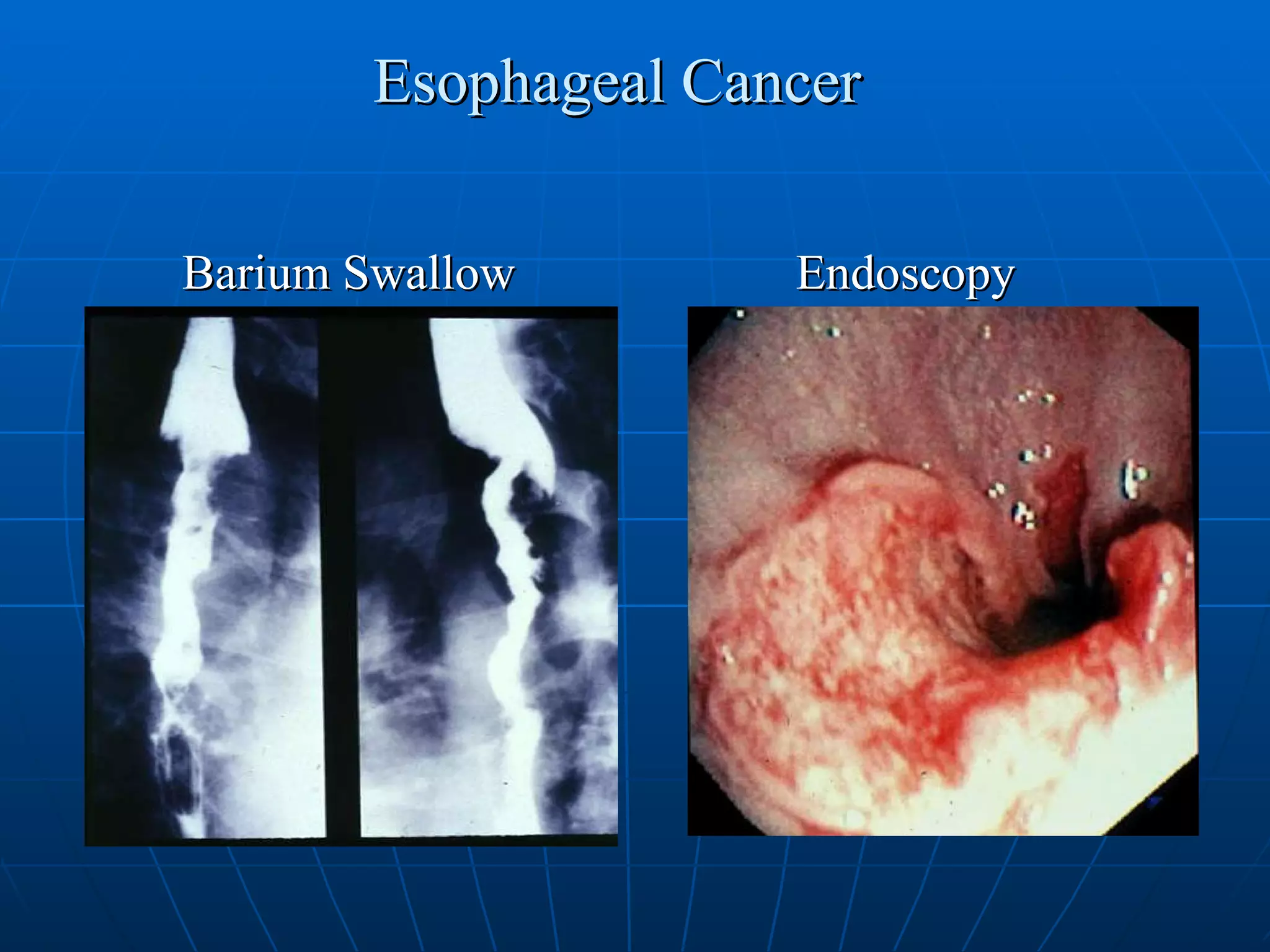 Esophageal Cancer Barium Swallow Endoscopy 