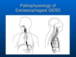 Pathophysiology of Extraesophageal GERD 
