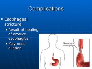 Complications Esophageal stricture Result of healing of erosive esophagitis May need dilation 