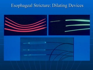 Esophageal Stricture: Dilating Devices 