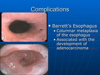 Complications Barrett’s Esophagus Columnar metaplasia of the esophagus  (AIIMS06) Associated with the development of adenocarcinoma  (AIMS97,06) 