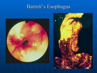 Barrett’s Esophagus 
