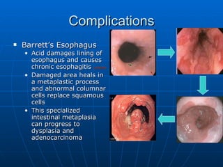 Complications Barrett’s Esophagus Acid damages lining of esophagus and causes chronic esophagitis  (AIIMS98) Damaged area heals in a metaplastic process and abnormal columnar cells replace squamous cells This specialized intestinal metaplasia can progress to dysplasia and adenocarcinoma 
